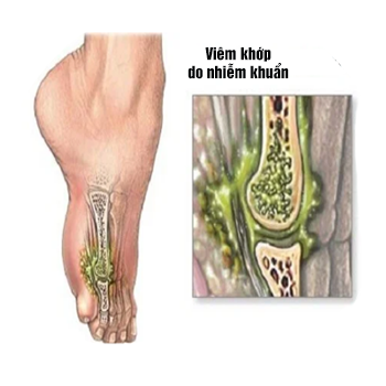 Nhiễm khuẩn